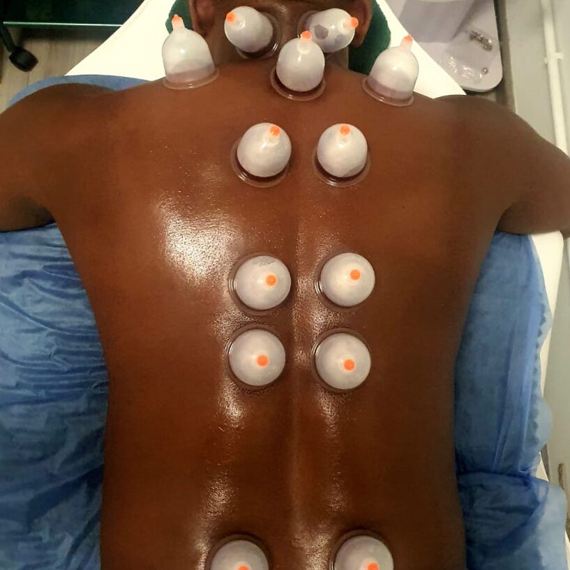 koryo cupping therapy