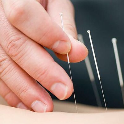 clinical acupuncture